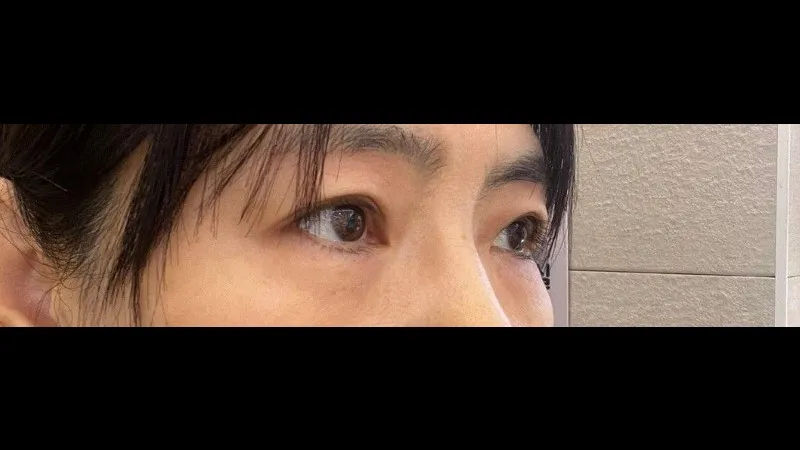Sub-brow Lift, Natural Adhesion Double Eyelid Surgery — RE&RE PLASTIC SURGERY 3