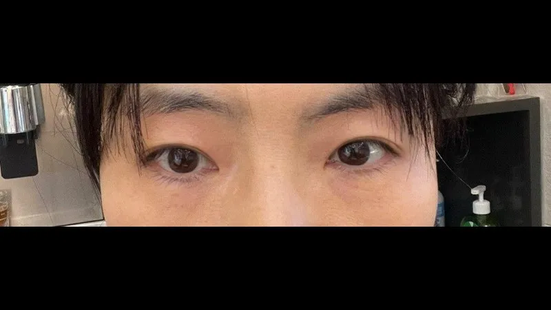 Sub-brow Lift, Natural Adhesion Double Eyelid Surgery — RE&RE PLASTIC SURGERY 4