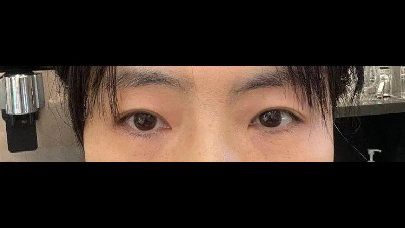 Sub-brow Lift, Natural Adhesion Double Eyelid Surgery — RE&RE PLASTIC SURGERY 5