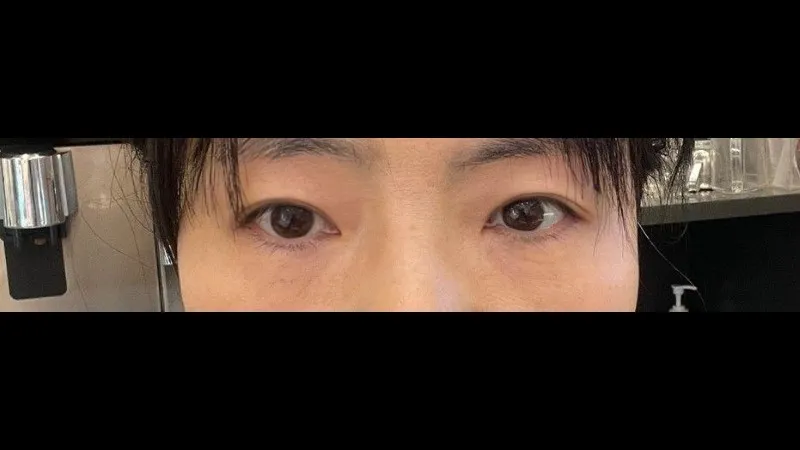 Sub-brow Lift, Natural Adhesion Double Eyelid Surgery — RE&RE PLASTIC SURGERY 6