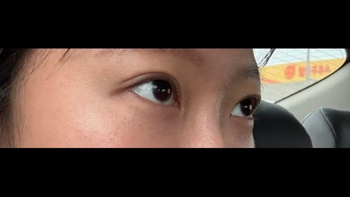 Natural Adhesion Double Eyelid Surgery, Ptosis Correction — RE&RE PLASTIC SURGERY 2