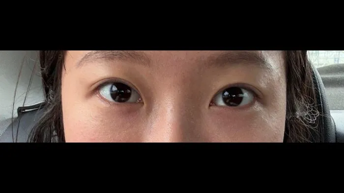 Natural Adhesion Double Eyelid Surgery, Ptosis Correction — RE&RE PLASTIC SURGERY 3