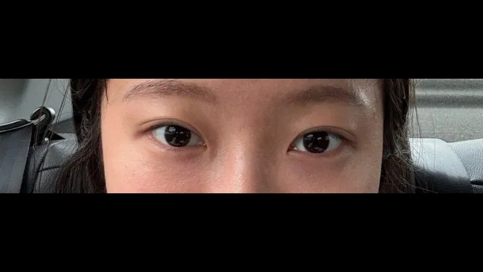 Natural Adhesion Double Eyelid Surgery, Ptosis Correction — RE&RE PLASTIC SURGERY 4