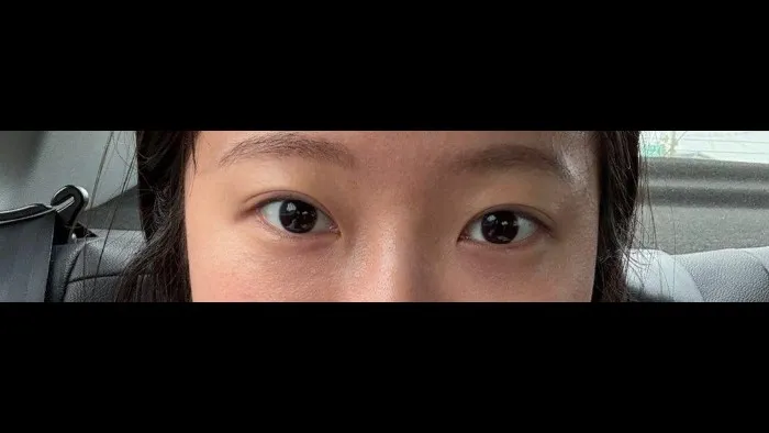 Natural Adhesion Double Eyelid Surgery, Ptosis Correction — RE&RE PLASTIC SURGERY 5