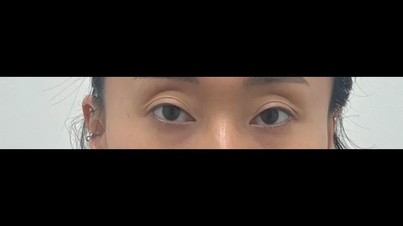 Partial Incision Double Eyelid Surgery, Ptosis Correction, Lower Eyelid Fat Grafting — RE&RE PLASTIC SURGERY 1