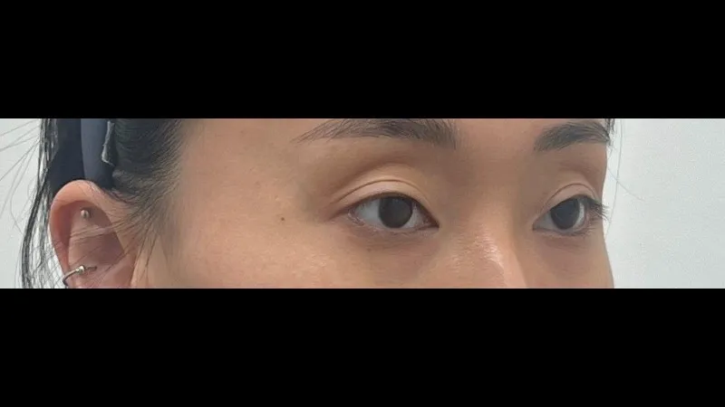 Partial Incision Double Eyelid Surgery, Ptosis Correction, Lower Eyelid Fat Grafting — RE&RE PLASTIC SURGERY 2
