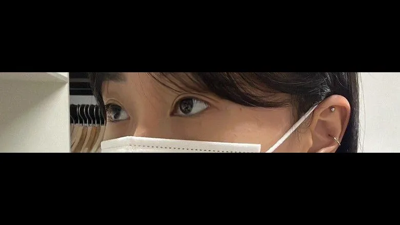 Partial Incision Double Eyelid Surgery, Ptosis Correction, Lower Eyelid Fat Grafting — RE&RE PLASTIC SURGERY 3
