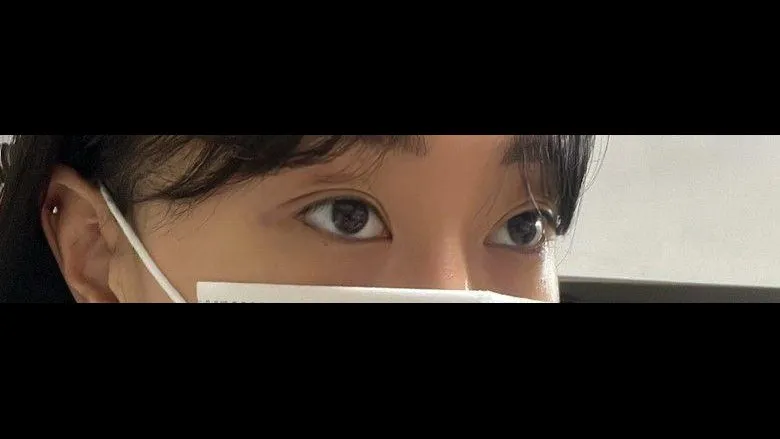 Partial Incision Double Eyelid Surgery, Ptosis Correction, Lower Eyelid Fat Grafting — RE&RE PLASTIC SURGERY 4