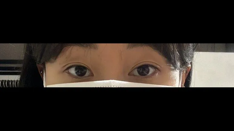 Partial Incision Double Eyelid Surgery, Ptosis Correction, Lower Eyelid Fat Grafting — RE&RE PLASTIC SURGERY 5