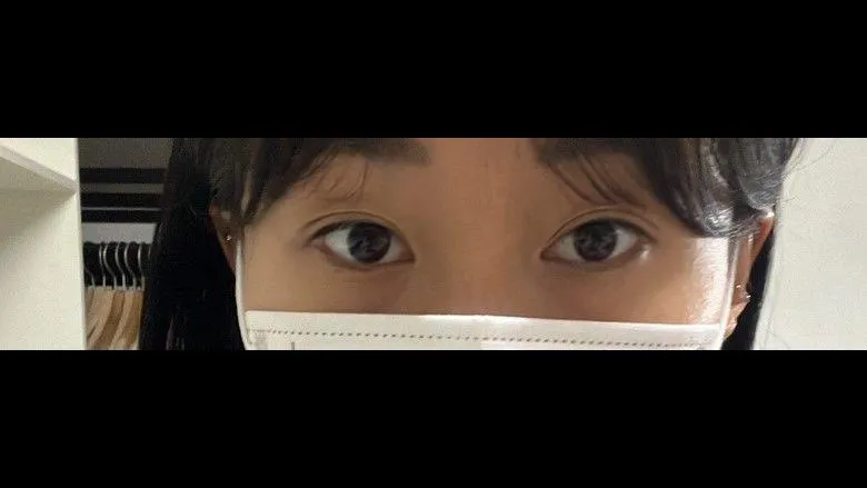 Partial Incision Double Eyelid Surgery, Ptosis Correction, Lower Eyelid Fat Grafting — RE&RE PLASTIC SURGERY 6