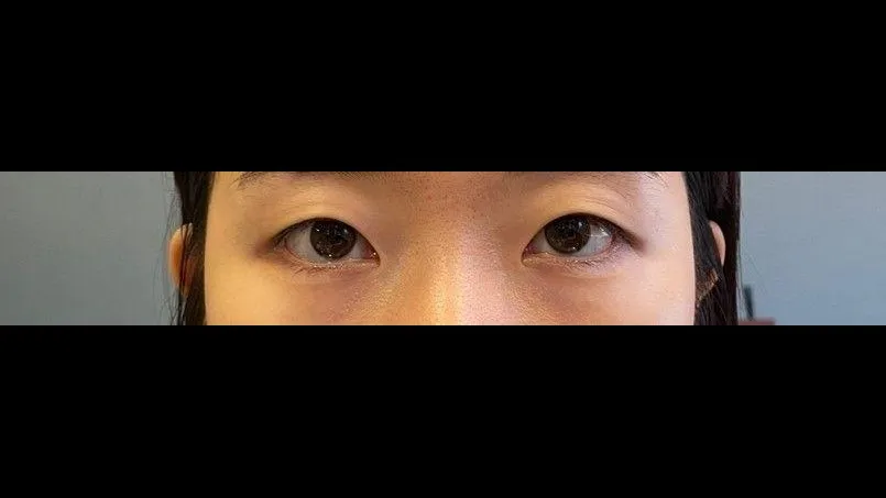 Natural Adhesion Double Eyelid Surgery — RE&RE PLASTIC SURGERY 1