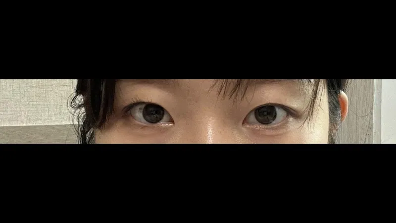 Natural Adhesion Double Eyelid Surgery — RE&RE PLASTIC SURGERY 2