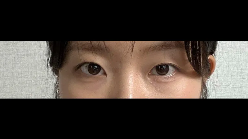Natural Adhesion Double Eyelid Surgery — RE&RE PLASTIC SURGERY 3