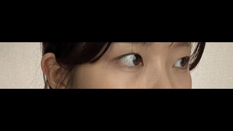 Natural Adhesion Double Eyelid Surgery — RE&RE PLASTIC SURGERY 4