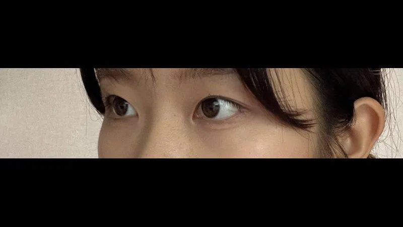 Natural Adhesion Double Eyelid Surgery — RE&RE PLASTIC SURGERY 5