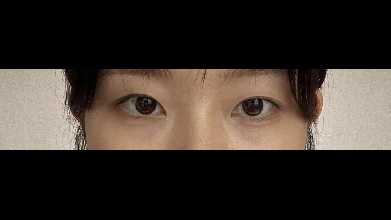 Natural Adhesion Double Eyelid Surgery — RE&RE PLASTIC SURGERY 6
