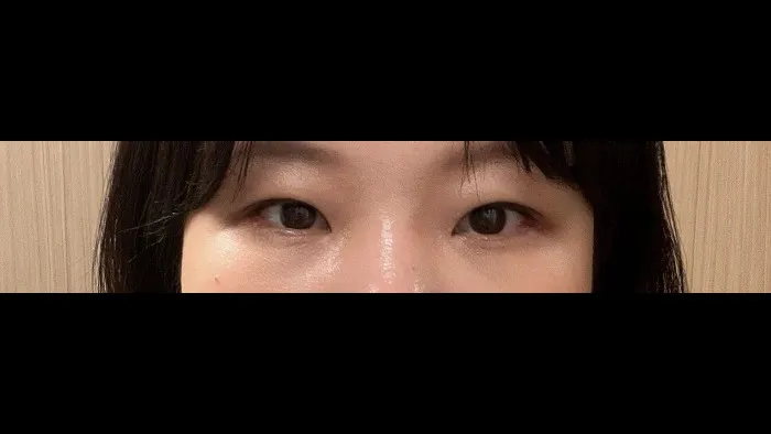 Natural Adhesion Double Eyelid Surgery, Ptosis Correction — RE&RE PLASTIC SURGERY 2