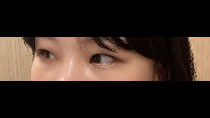 Natural Adhesion Double Eyelid Surgery, Ptosis Correction — RE&RE PLASTIC SURGERY 3