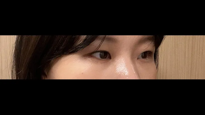 Natural Adhesion Double Eyelid Surgery, Ptosis Correction — RE&RE PLASTIC SURGERY 4