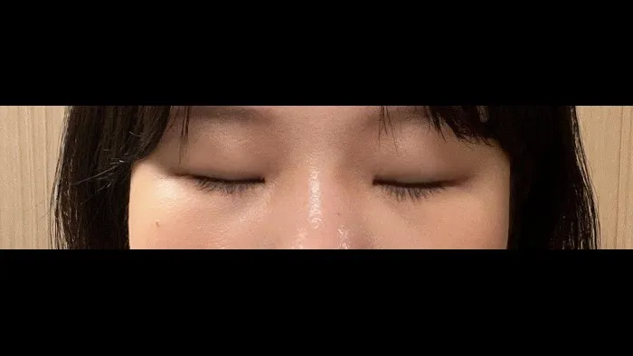 Natural Adhesion Double Eyelid Surgery, Ptosis Correction — RE&RE PLASTIC SURGERY 5