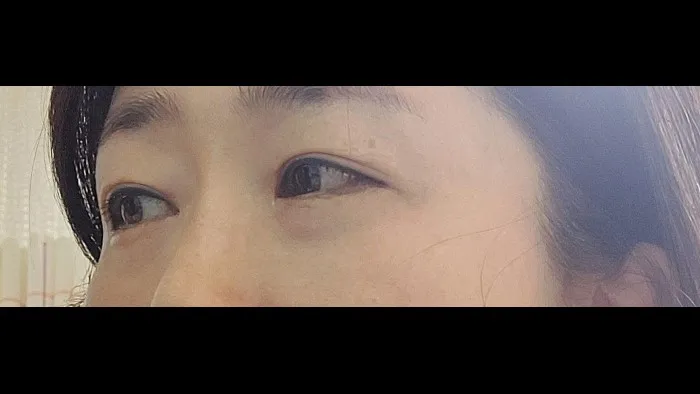 Sub-brow Lift, Ptosis Correction, Lower Eyelid Fat Grafting, Lower Blepharoplasty (Aging Eye Rejuvenation) — RE&RE PLASTIC SURGERY 2