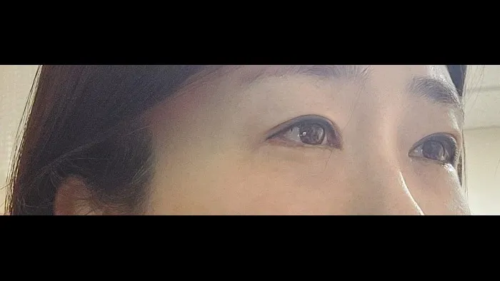 Sub-brow Lift, Ptosis Correction, Lower Eyelid Fat Grafting, Lower Blepharoplasty (Aging Eye Rejuvenation) — RE&RE PLASTIC SURGERY 3