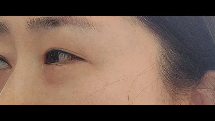 Sub-brow Lift, Ptosis Correction, Lower Eyelid Fat Grafting, Lower Blepharoplasty (Aging Eye Rejuvenation) — RE&RE PLASTIC SURGERY 4