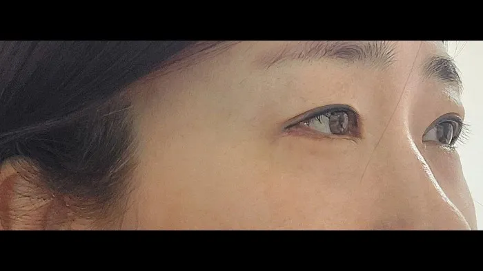 Sub-brow Lift, Ptosis Correction, Lower Eyelid Fat Grafting, Lower Blepharoplasty (Aging Eye Rejuvenation) — RE&RE PLASTIC SURGERY 5