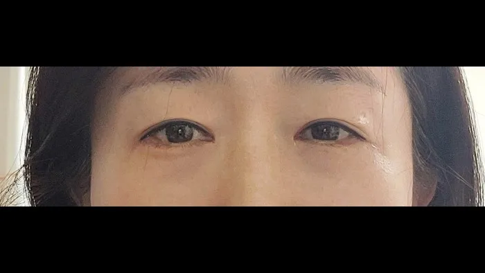 Sub-brow Lift, Ptosis Correction, Lower Eyelid Fat Grafting, Lower Blepharoplasty (Aging Eye Rejuvenation) — RE&RE PLASTIC SURGERY 6