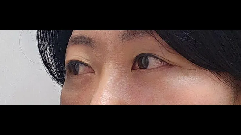 Sub-brow Lift, Lower Blepharoplasty (Aging Eye Rejuvenation) — RE&RE PLASTIC SURGERY 2