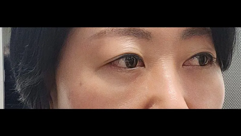 Sub-brow Lift, Lower Blepharoplasty (Aging Eye Rejuvenation) — RE&RE PLASTIC SURGERY 3