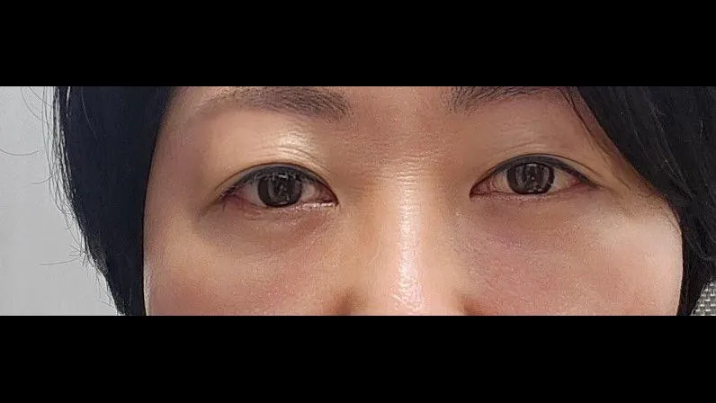 Sub-brow Lift, Lower Blepharoplasty (Aging Eye Rejuvenation) — RE&RE PLASTIC SURGERY 4
