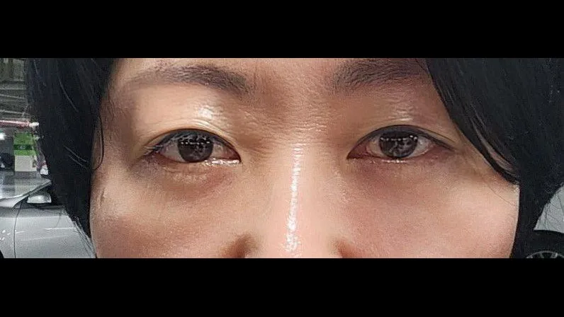 Sub-brow Lift, Lower Blepharoplasty (Aging Eye Rejuvenation) — RE&RE PLASTIC SURGERY 5