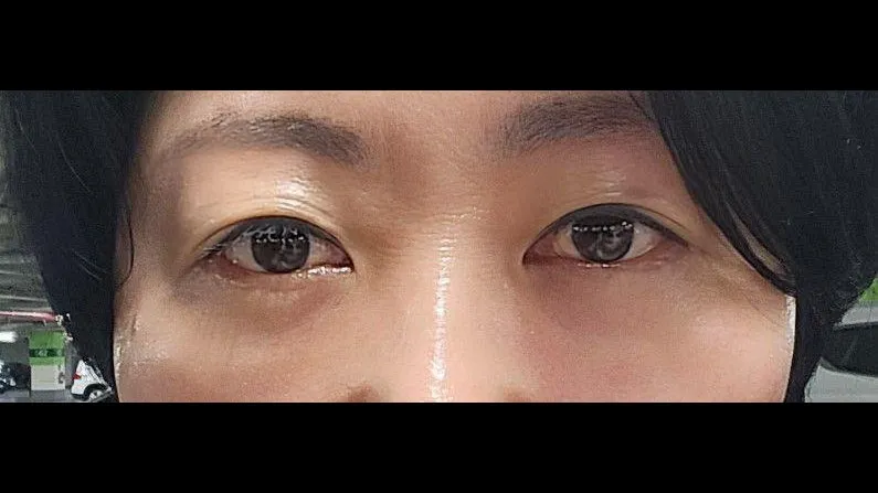 Sub-brow Lift, Lower Blepharoplasty (Aging Eye Rejuvenation) — RE&RE PLASTIC SURGERY 6