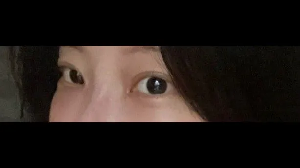 Natural Adhesion Double Eyelid Surgery, Ptosis Correction, Lower Eyelid Fat Repositioning, Lower Eyelid Fat Grafting — RE&RE PLASTIC SURGERY 2