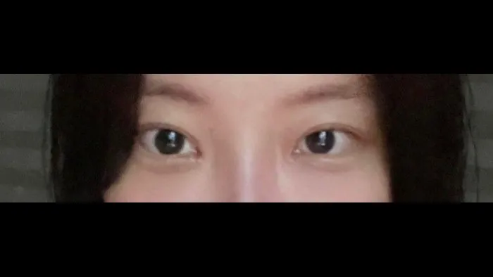 Natural Adhesion Double Eyelid Surgery, Ptosis Correction, Lower Eyelid Fat Repositioning, Lower Eyelid Fat Grafting — RE&RE PLASTIC SURGERY 3