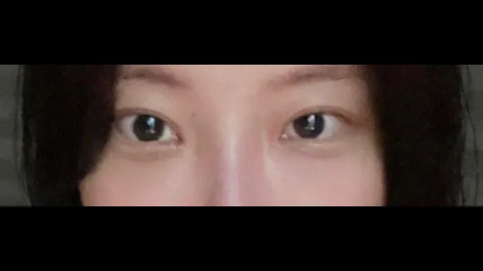 Natural Adhesion Double Eyelid Surgery, Ptosis Correction, Lower Eyelid Fat Repositioning, Lower Eyelid Fat Grafting — RE&RE PLASTIC SURGERY 4