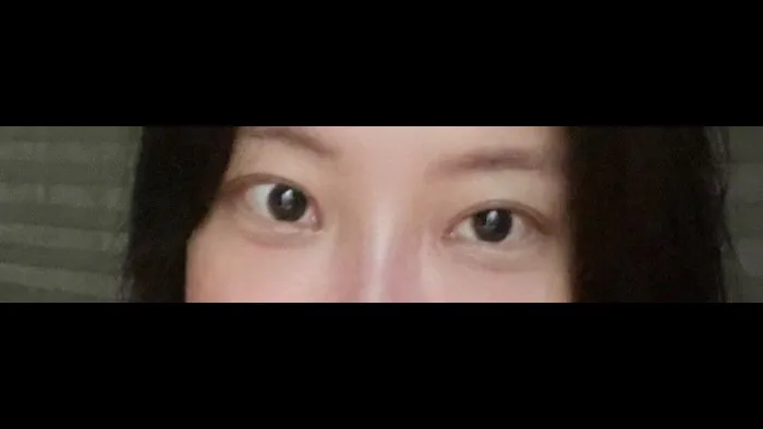 Natural Adhesion Double Eyelid Surgery, Ptosis Correction, Lower Eyelid Fat Repositioning, Lower Eyelid Fat Grafting — RE&RE PLASTIC SURGERY 5