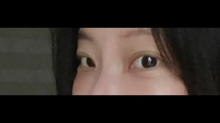 Natural Adhesion Double Eyelid Surgery, Ptosis Correction, Lower Eyelid Fat Repositioning, Lower Eyelid Fat Grafting — RE&RE PLASTIC SURGERY 6