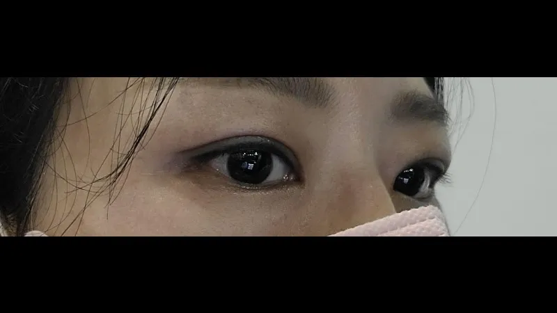 Incisional Double Eyelid Surgery — RE&RE PLASTIC SURGERY 2
