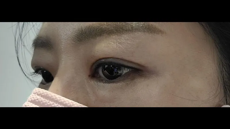 Incisional Double Eyelid Surgery — RE&RE PLASTIC SURGERY 3