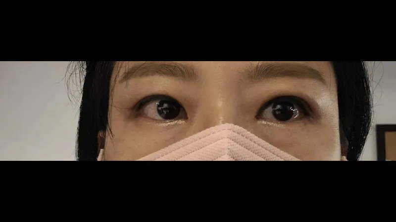Incisional Double Eyelid Surgery — RE&RE PLASTIC SURGERY 4
