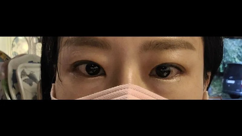 Incisional Double Eyelid Surgery — RE&RE PLASTIC SURGERY 5