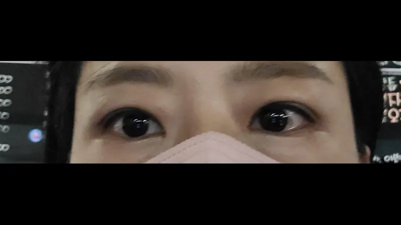 Incisional Double Eyelid Surgery — RE&RE PLASTIC SURGERY 6