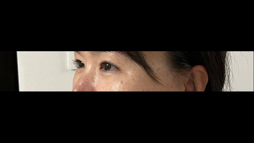 Incisional Double Eyelid Surgery — RE&RE PLASTIC SURGERY 2