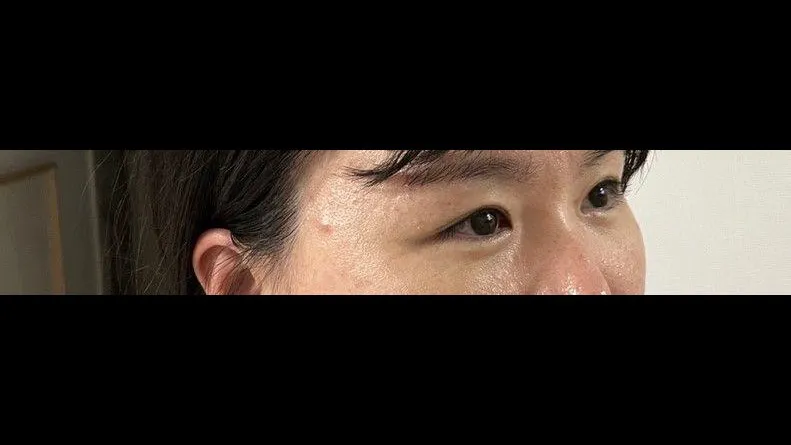 Incisional Double Eyelid Surgery — RE&RE PLASTIC SURGERY 3