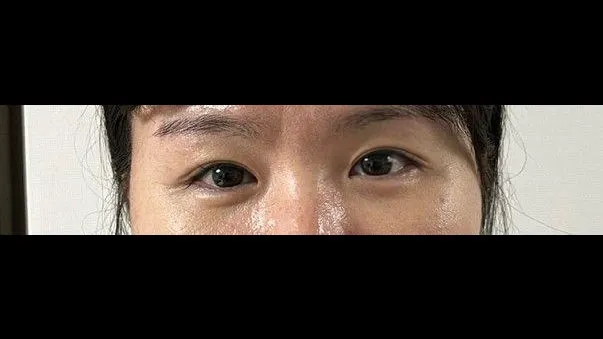 Incisional Double Eyelid Surgery — RE&RE PLASTIC SURGERY 5