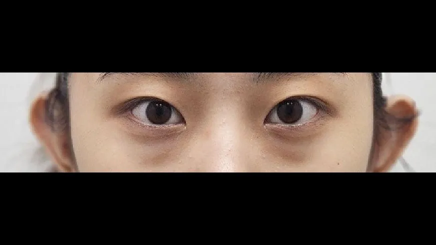Natural Adhesion Double Eyelid Surgery, Lower Eyelid Fat Repositioning, Lower Eyelid Fat Grafting — RE&RE PLASTIC SURGERY 1