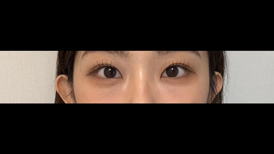 Natural Adhesion Double Eyelid Surgery, Lower Eyelid Fat Repositioning, Lower Eyelid Fat Grafting — RE&RE PLASTIC SURGERY 2
