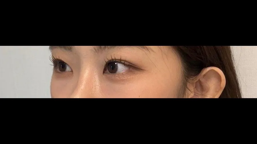 Natural Adhesion Double Eyelid Surgery, Lower Eyelid Fat Repositioning, Lower Eyelid Fat Grafting — RE&RE PLASTIC SURGERY 3